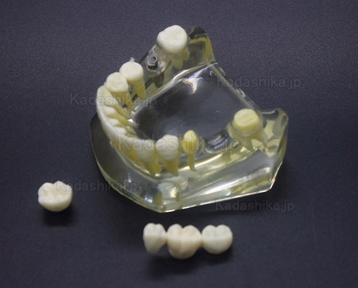 歯科インプラント説明用模型 (インプラントとブリッジの違い説明)