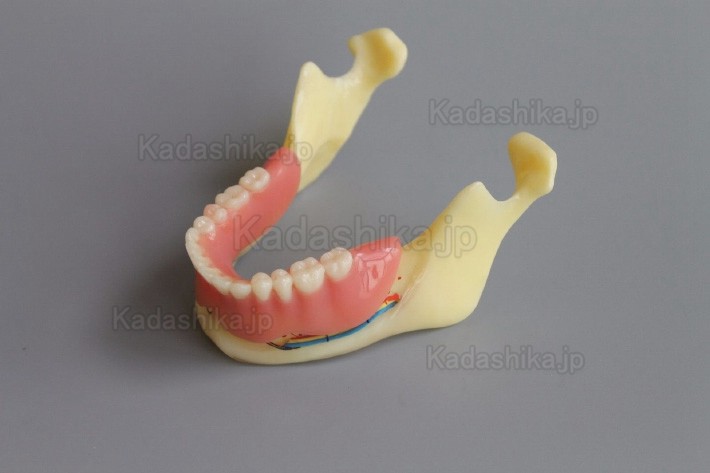 下顎骨組織とインプラント模型 + オーバーデンチャーモデル ＃2014 02